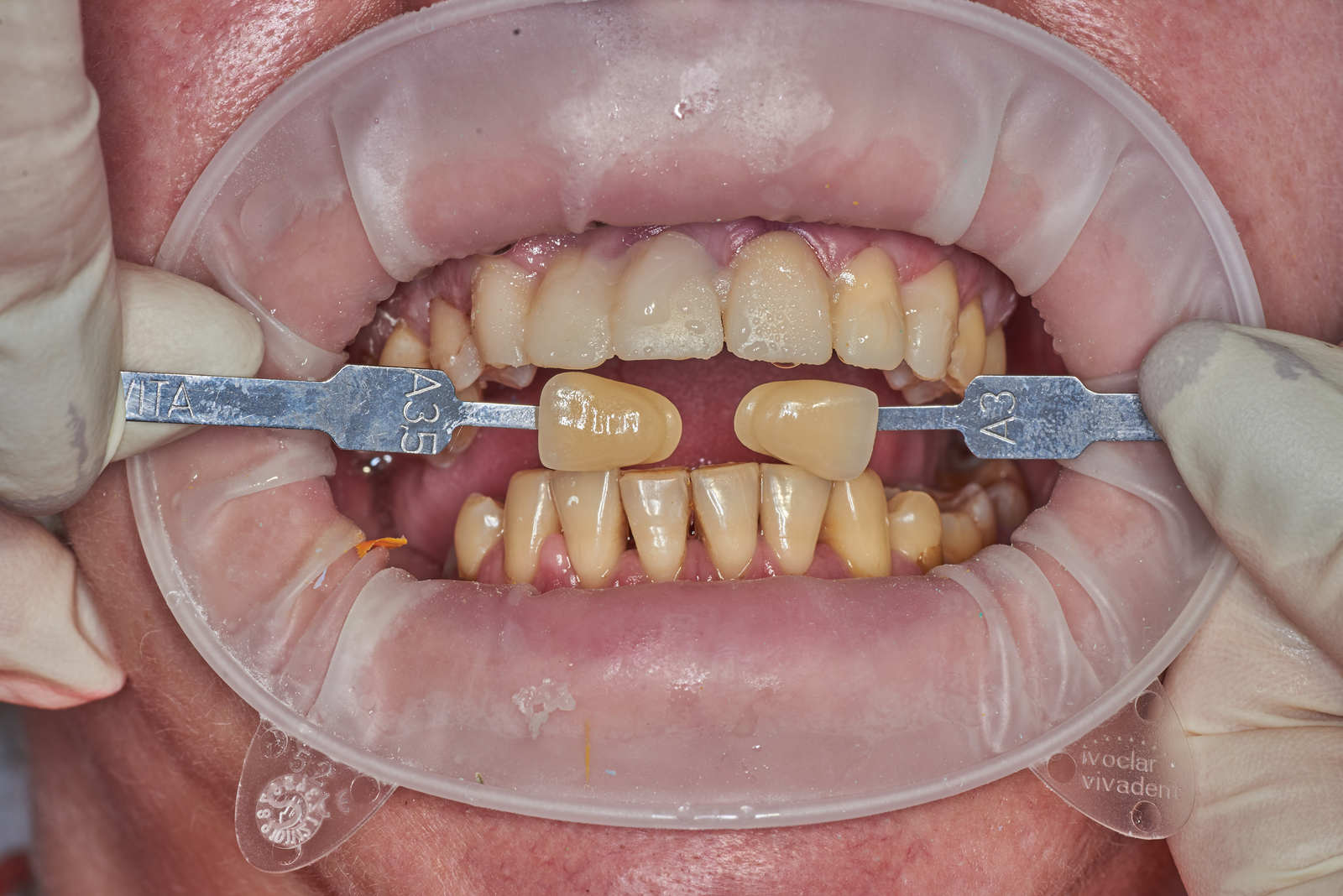 A little makeover - My, Teeth, cermet, Dentistry, Crowns, Work, Longpost