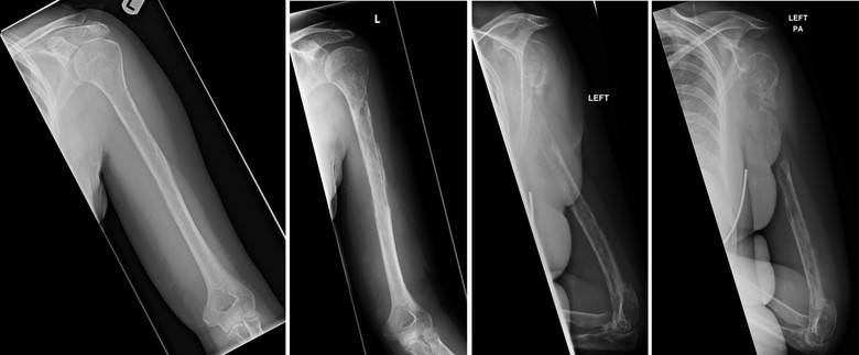 Vanishing bone syndrome - Disease, Bones, Longpost, The medicine