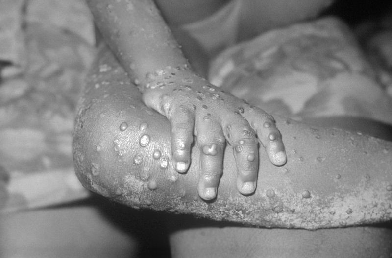 Monkeypox came to Europe. Fever, vomiting and blisters all over the body. - Epidemic, Monkeypox, Great Britain, news