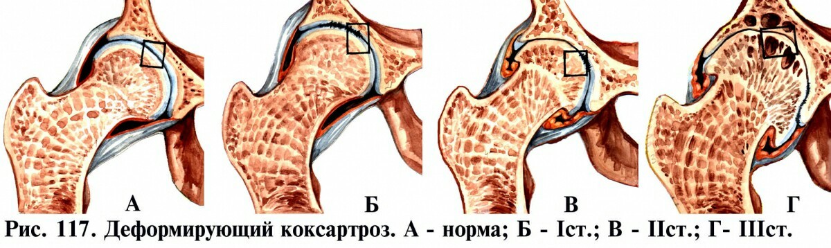 Медицинская реформа действует - Моё, Суставы, Коксартроз, Болезнь, Медицина, Реформа