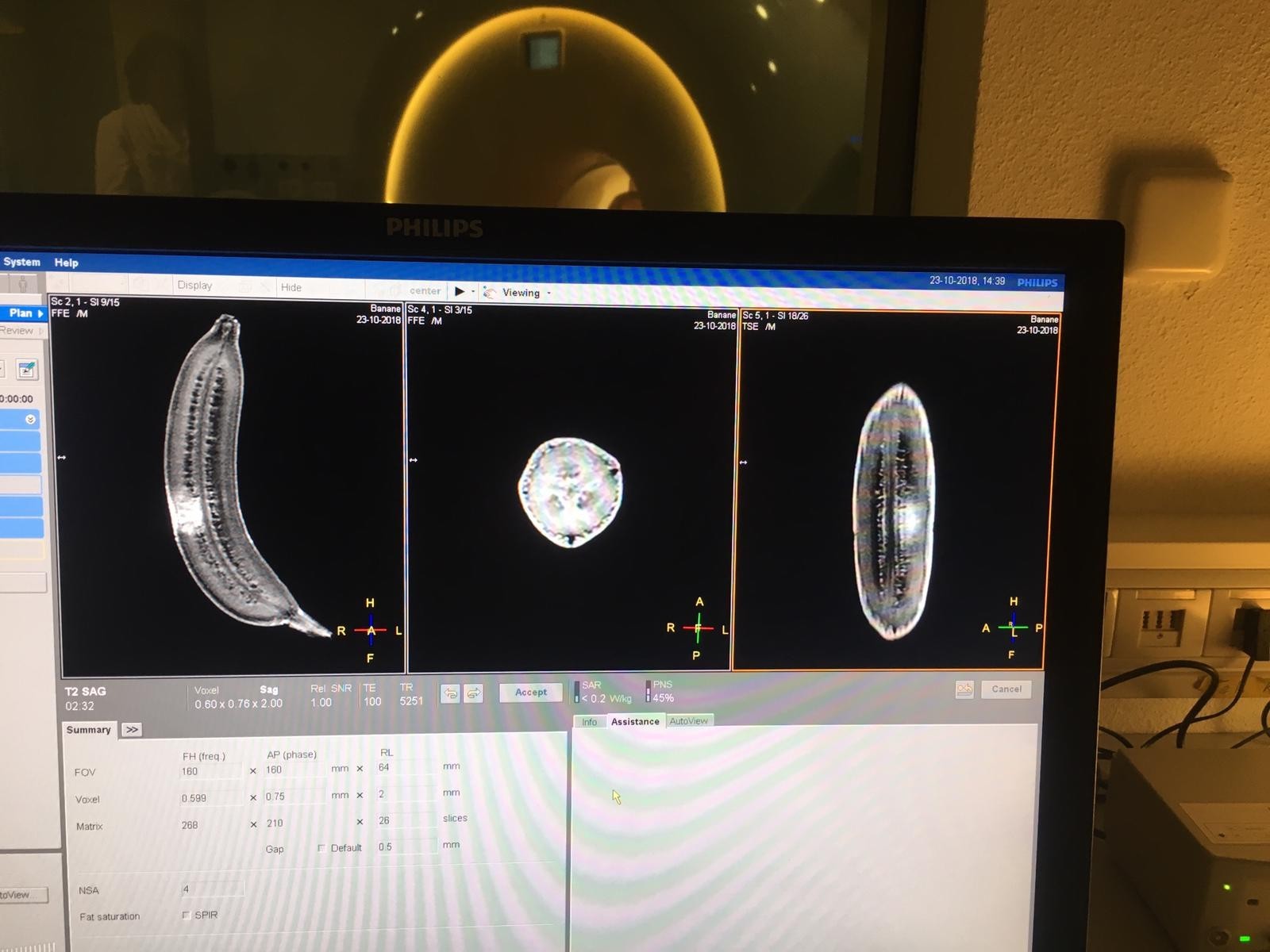 This is what a banana looks like in an MRI, 1.5 Tesla - My, Radiology, MRI, The medicine, Banana