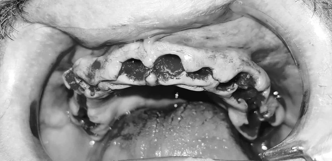 To all my subscribers - what I chose and what happened in the end - My, Dentistry, Implantation, No rating, Teeth, Longpost