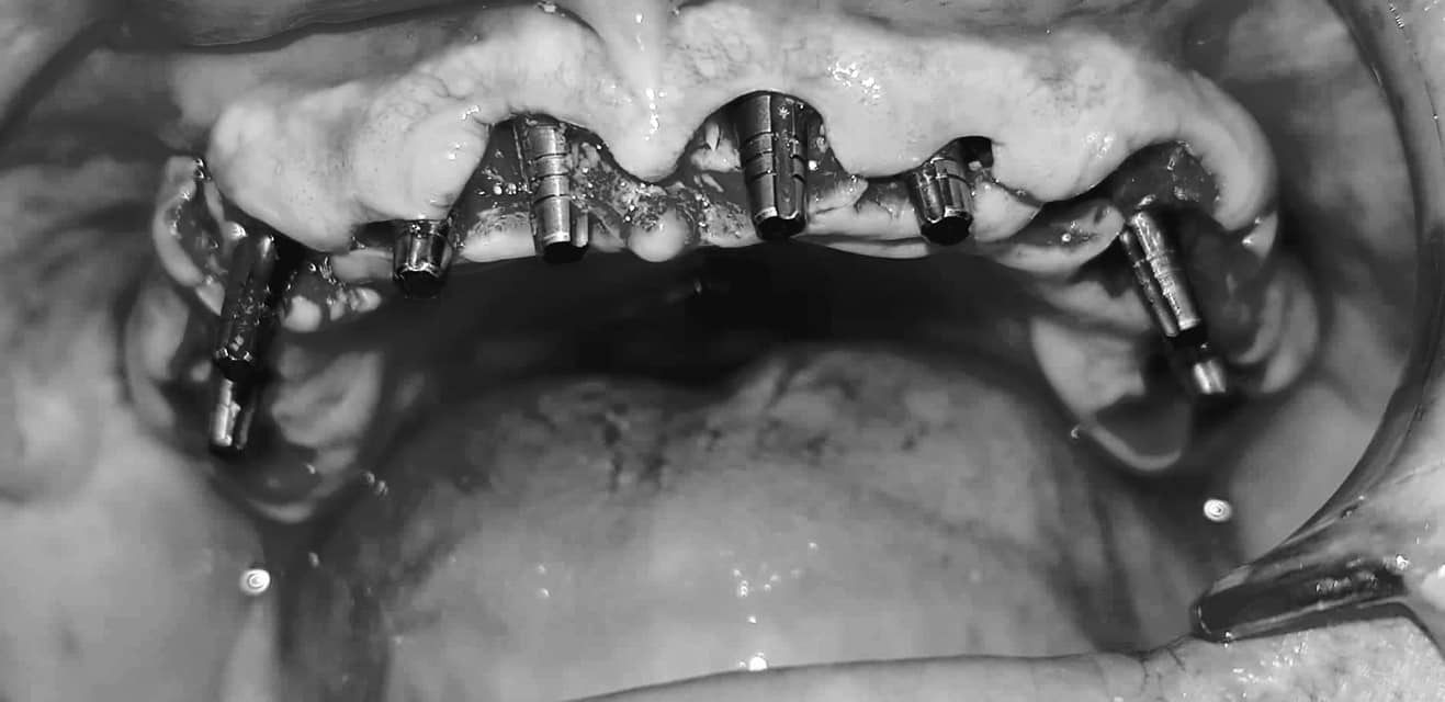 To all my subscribers - what I chose and what happened in the end - My, Dentistry, Implantation, No rating, Teeth, Longpost