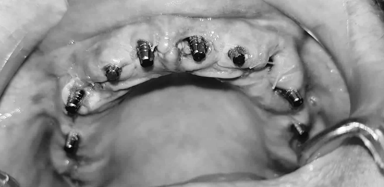 To all my subscribers - what I chose and what happened in the end - My, Dentistry, Implantation, No rating, Teeth, Longpost