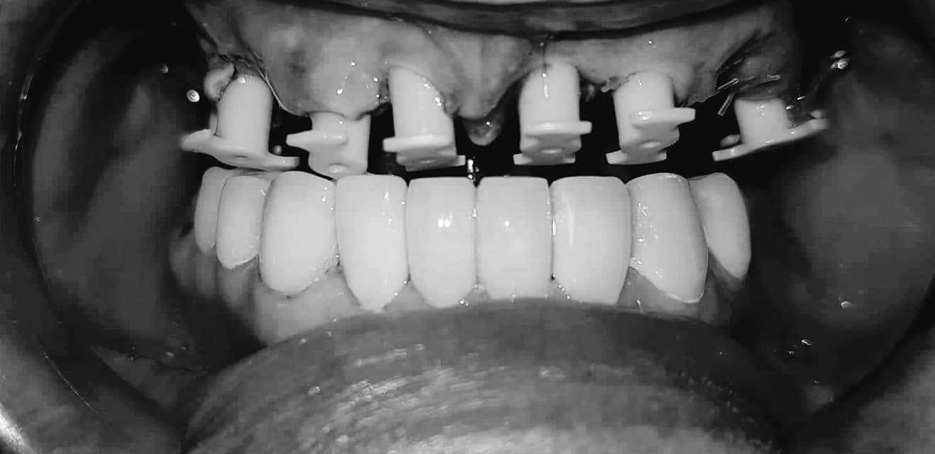 To all my subscribers - what I chose and what happened in the end - My, Dentistry, Implantation, No rating, Teeth, Longpost