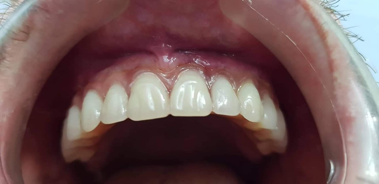 To all my subscribers - what I chose and what happened in the end - My, Dentistry, Implantation, No rating, Teeth, Longpost