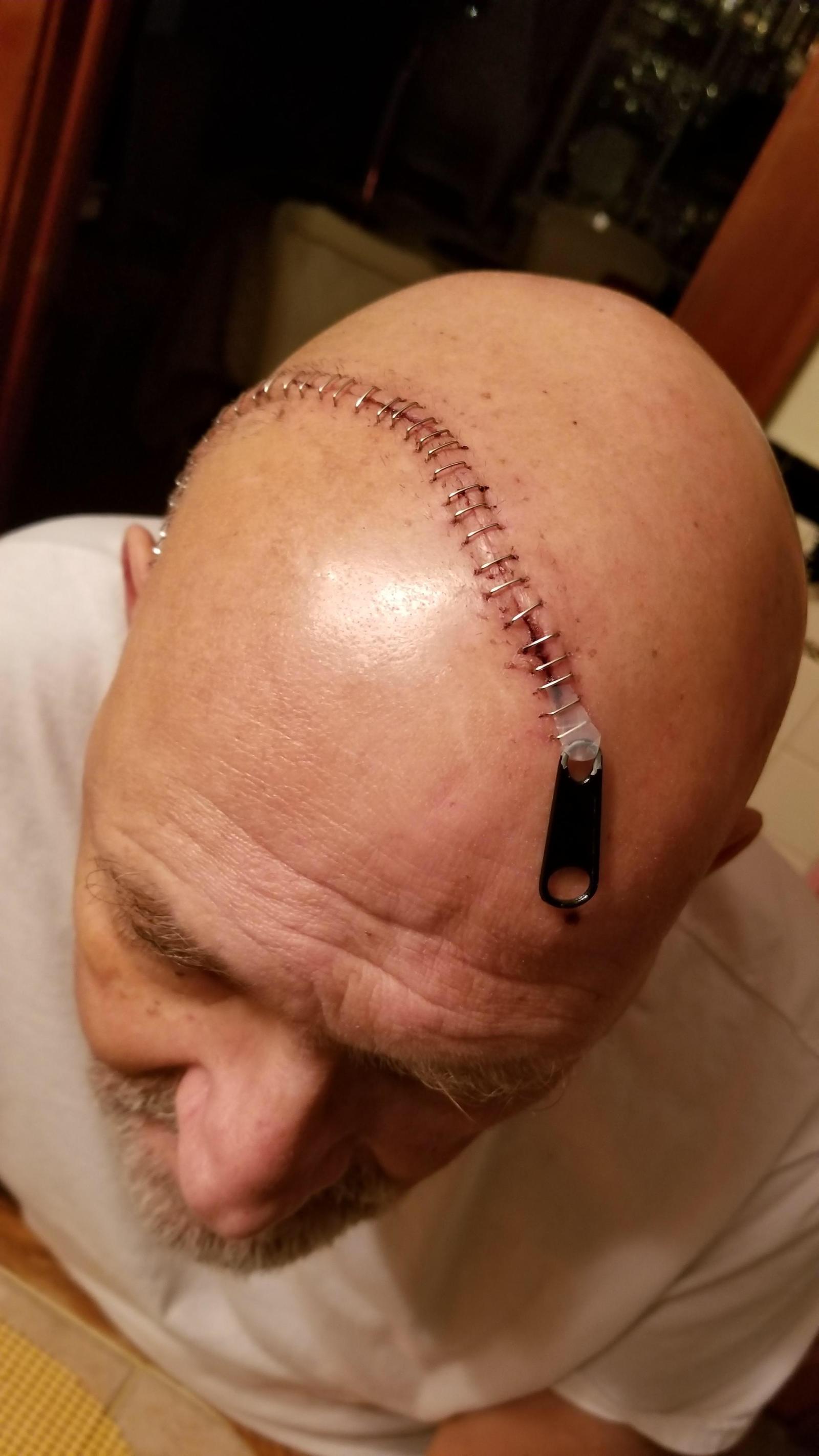 Survivor of skull surgery decided to joke a little - Seams, The medicine, Operation, Scull, Lightning, Humor, Clip