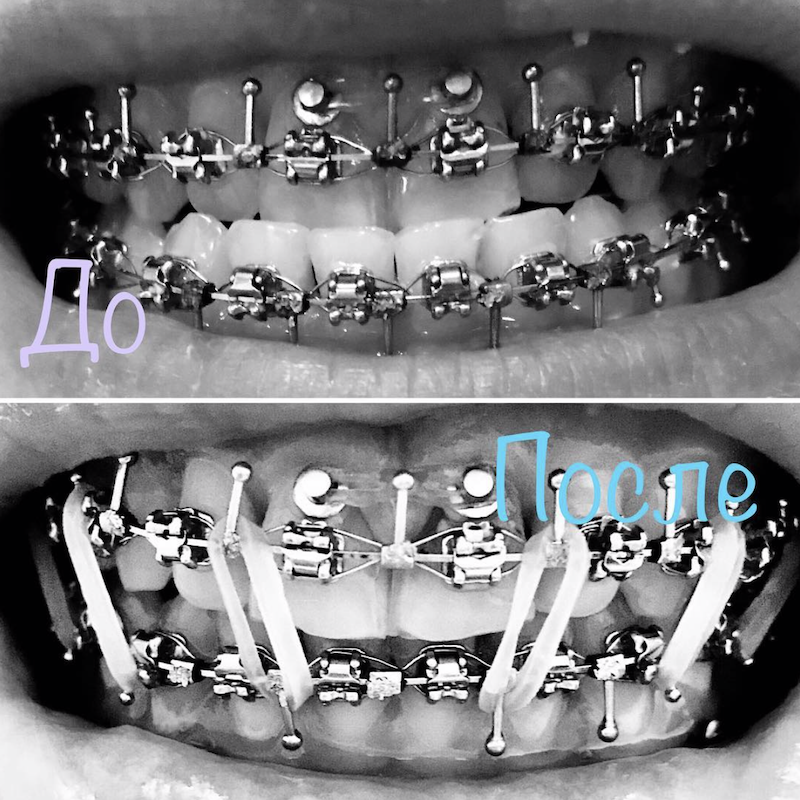 Вторая часть моих ортодонтических похождений. - Моё, Ортодонтия, Стоматология, Виниры, Хирургия, Зубы, Брекеты, Видео, Длиннопост