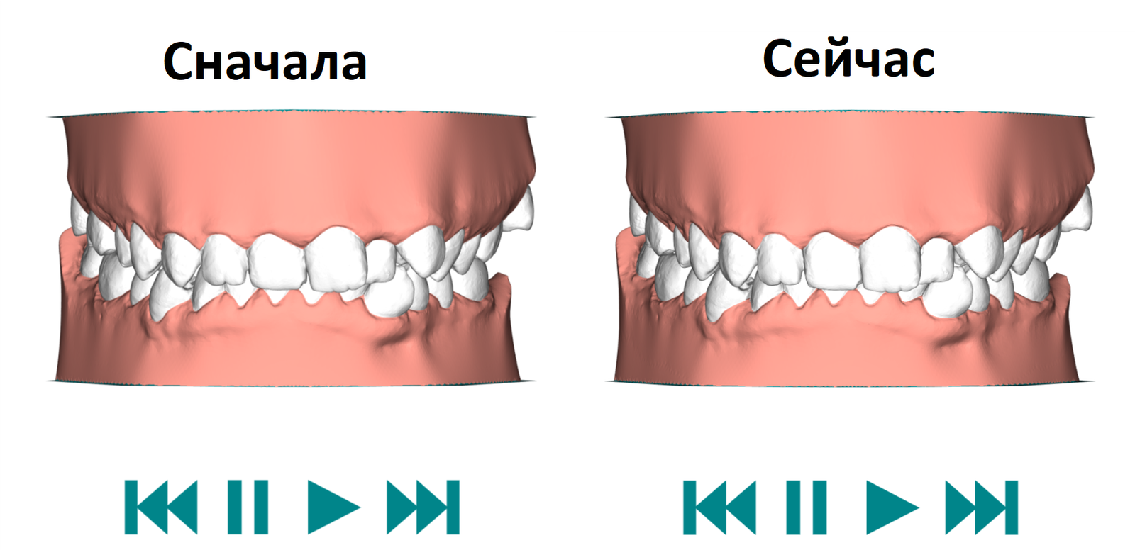 Aligners. Third pair. 1-14 days of wear - Malocclusion, Personal experience, My, Aligners, Bite correction