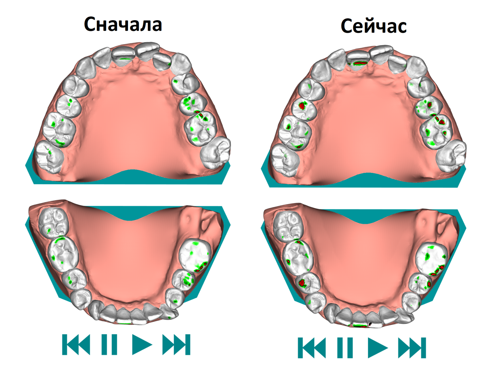 Aligners. Third pair. 1-14 days of wear - My, Aligners, Bite correction, Malocclusion, Personal experience