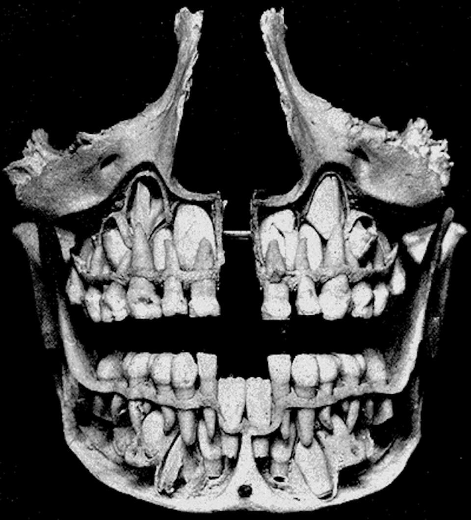 фото челюсти без зубов
