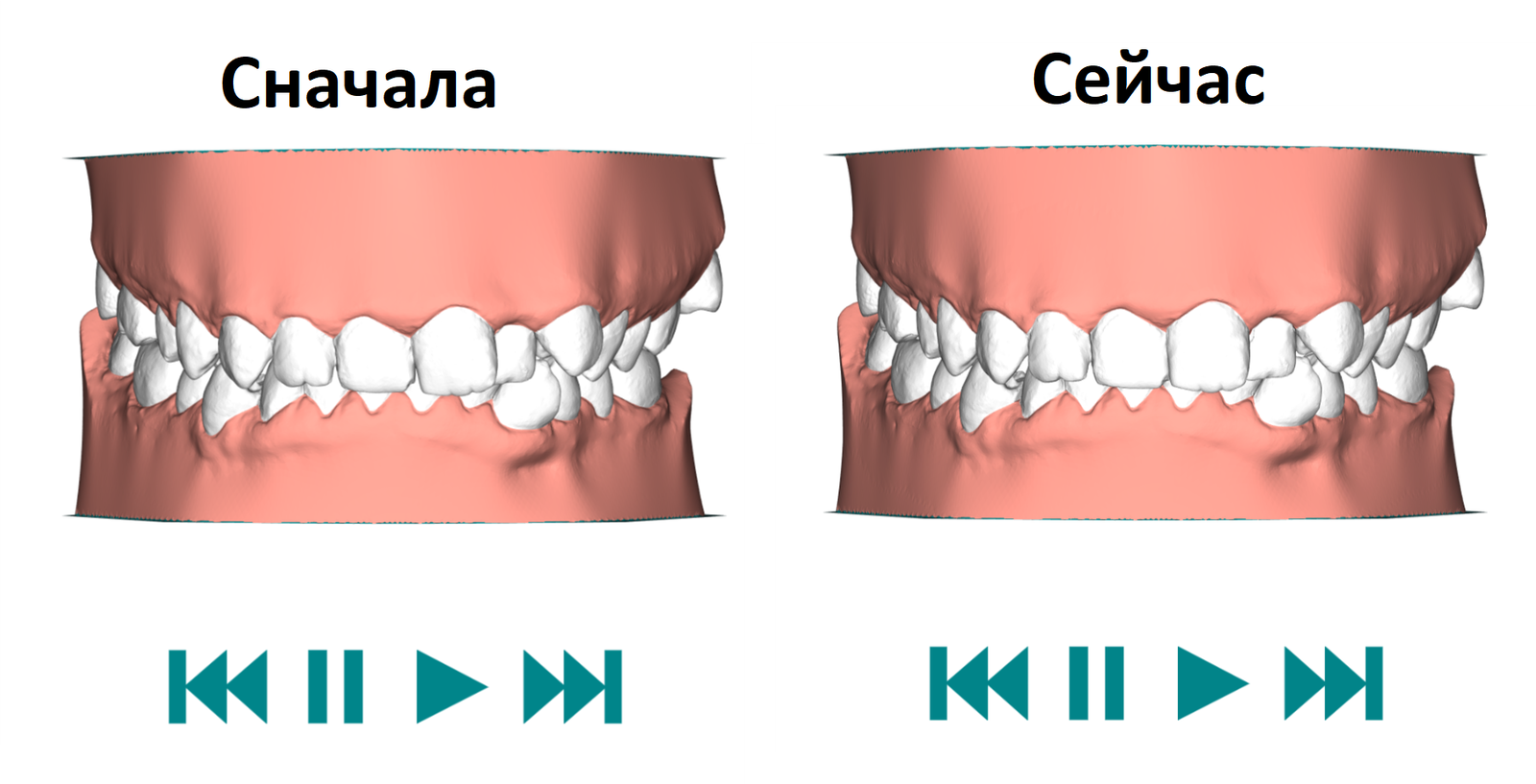 Aligners. Seventh pair. 1-11 days of wear - Personal experience, My, Aligners, Bite correction, Malocclusion