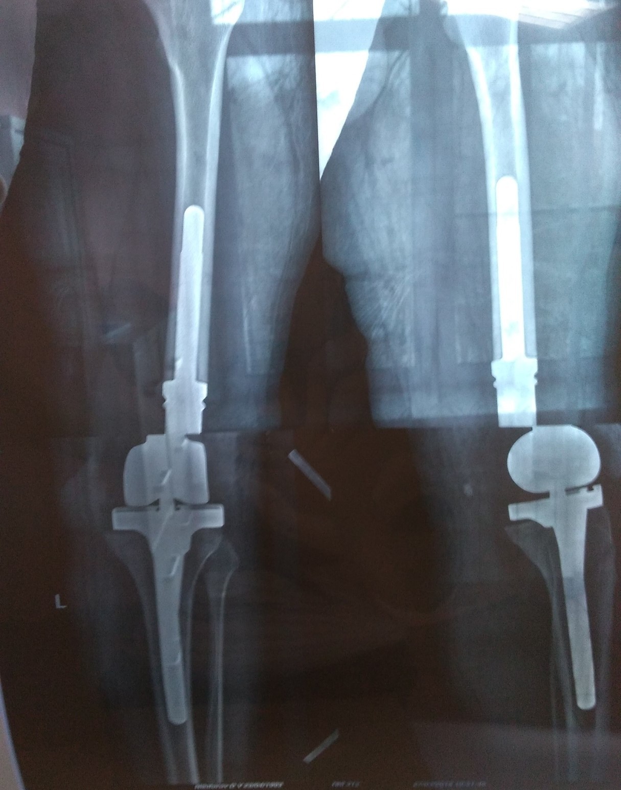 Endoprosthesis or how I became a cyborg! - My, Endoprosthetics, Sarcoma, Joints, The medicine, Longpost, Text