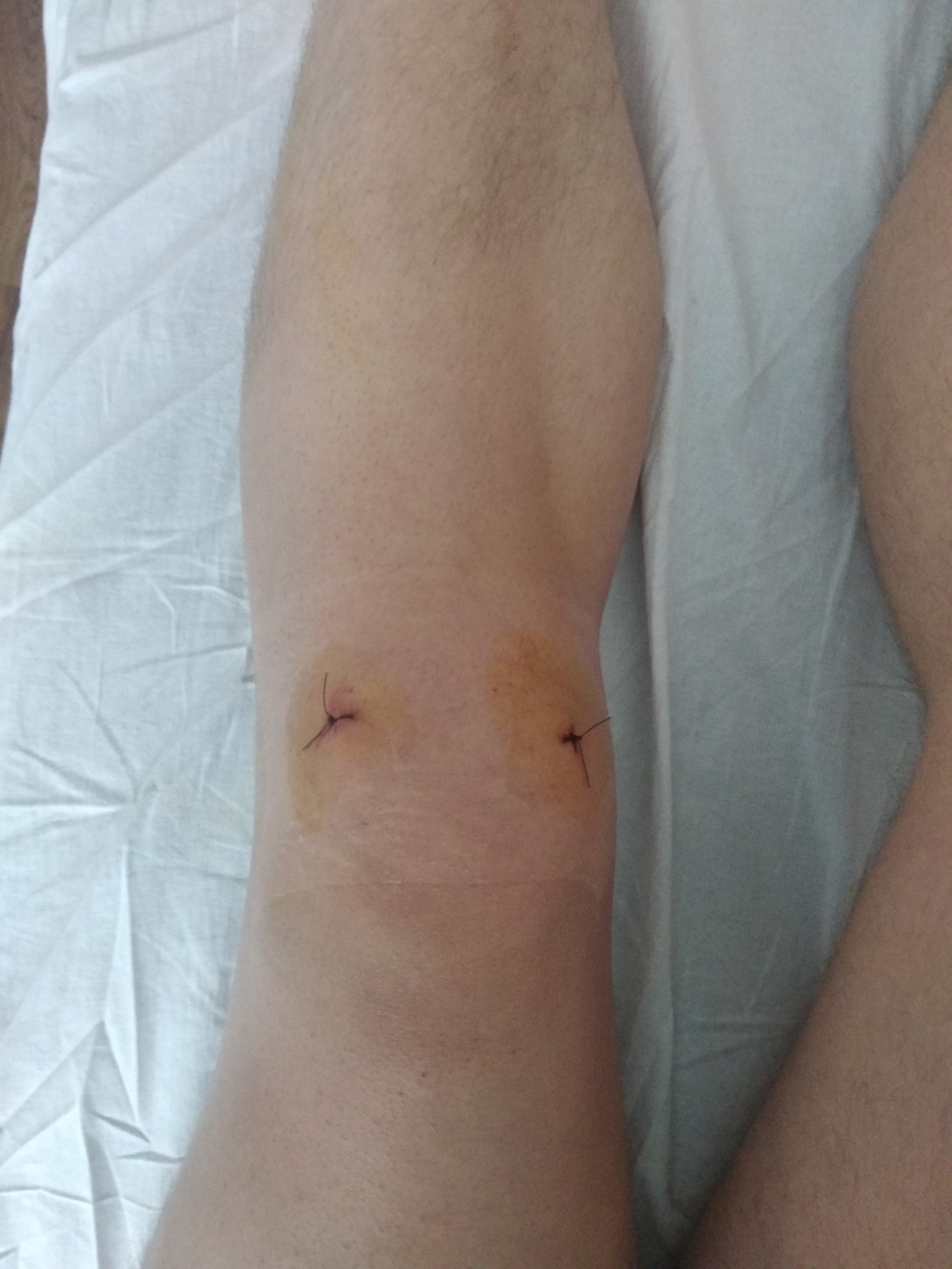 How is it in Moscow hospitals (knee arthroscopy) - My, Hospital, Arthroscopy, Injury, Hyde, Longpost