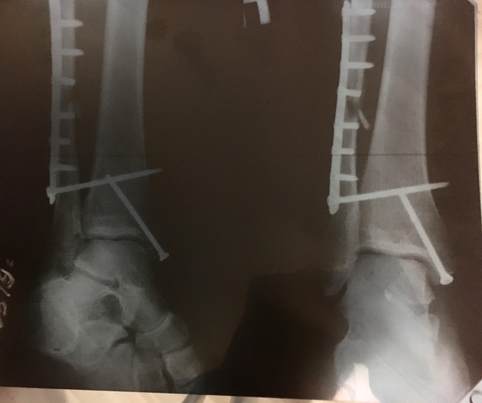 Another breakdown - My, Broken leg, Losers, Longpost