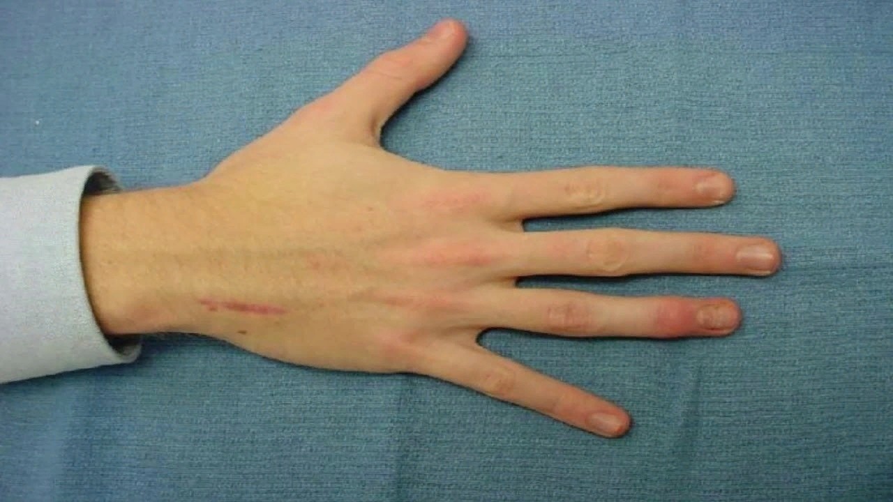 Arachnodactyly (literally spider fingers) - Pathology, Anatomy, Longpost