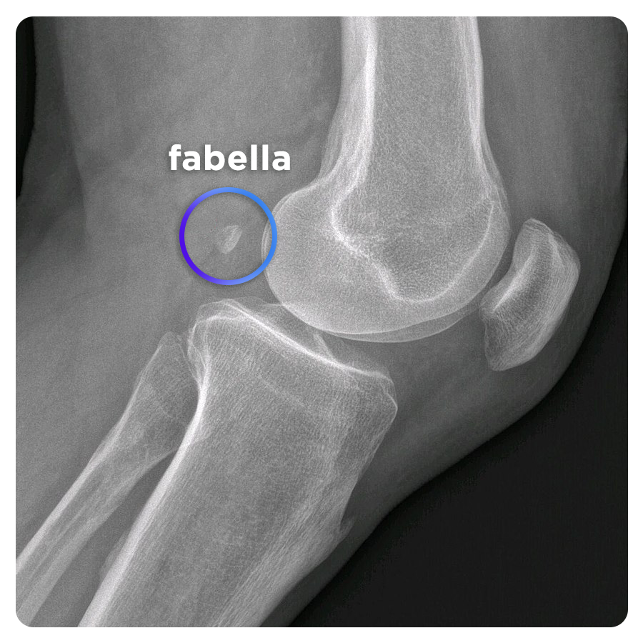 Fabella: the return of a lost bone to the human body. - Translation, The Telegraph, , Evolution, Charles Darwin, Longpost