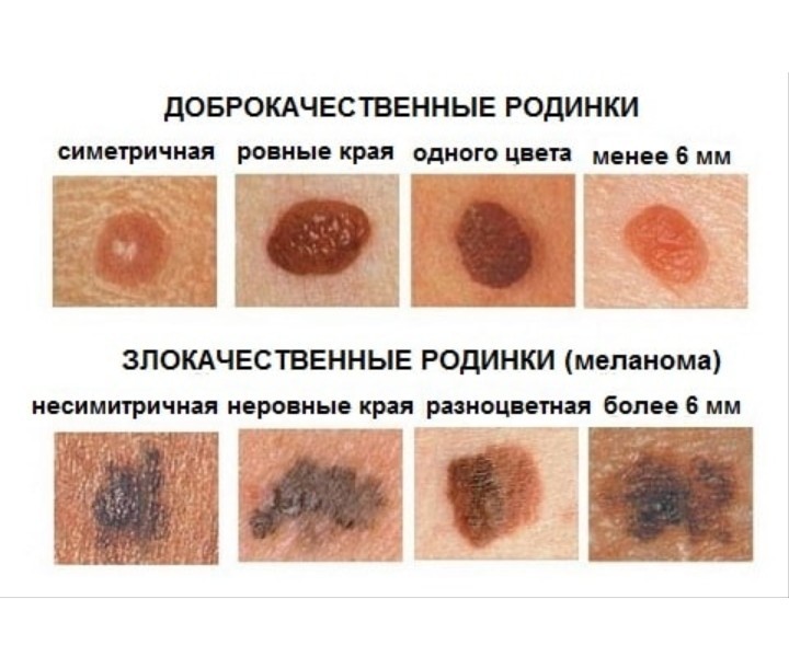 Меланома — рак кожи
