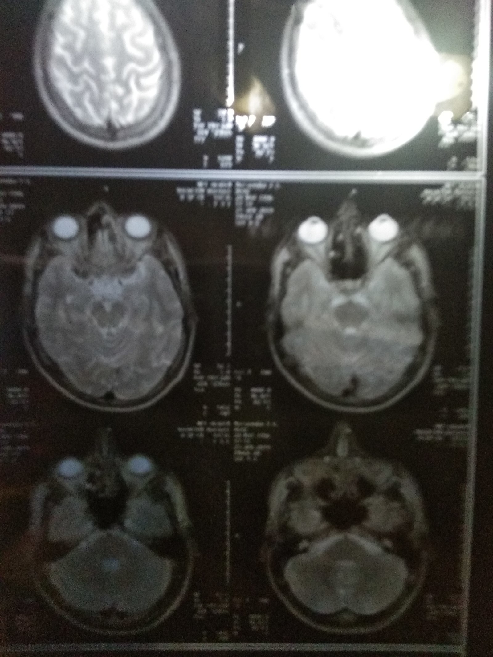 MRI of the brain. Cyst - My, Cyst, MRI, Doctors, Neurosurgery, The medicine, Longpost