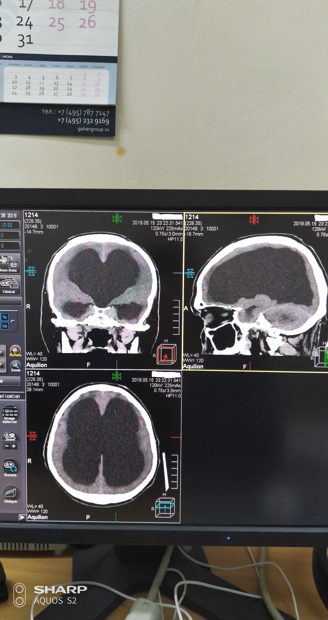 A man without a brain, my version. - My, X-ray, Brain, The medicine