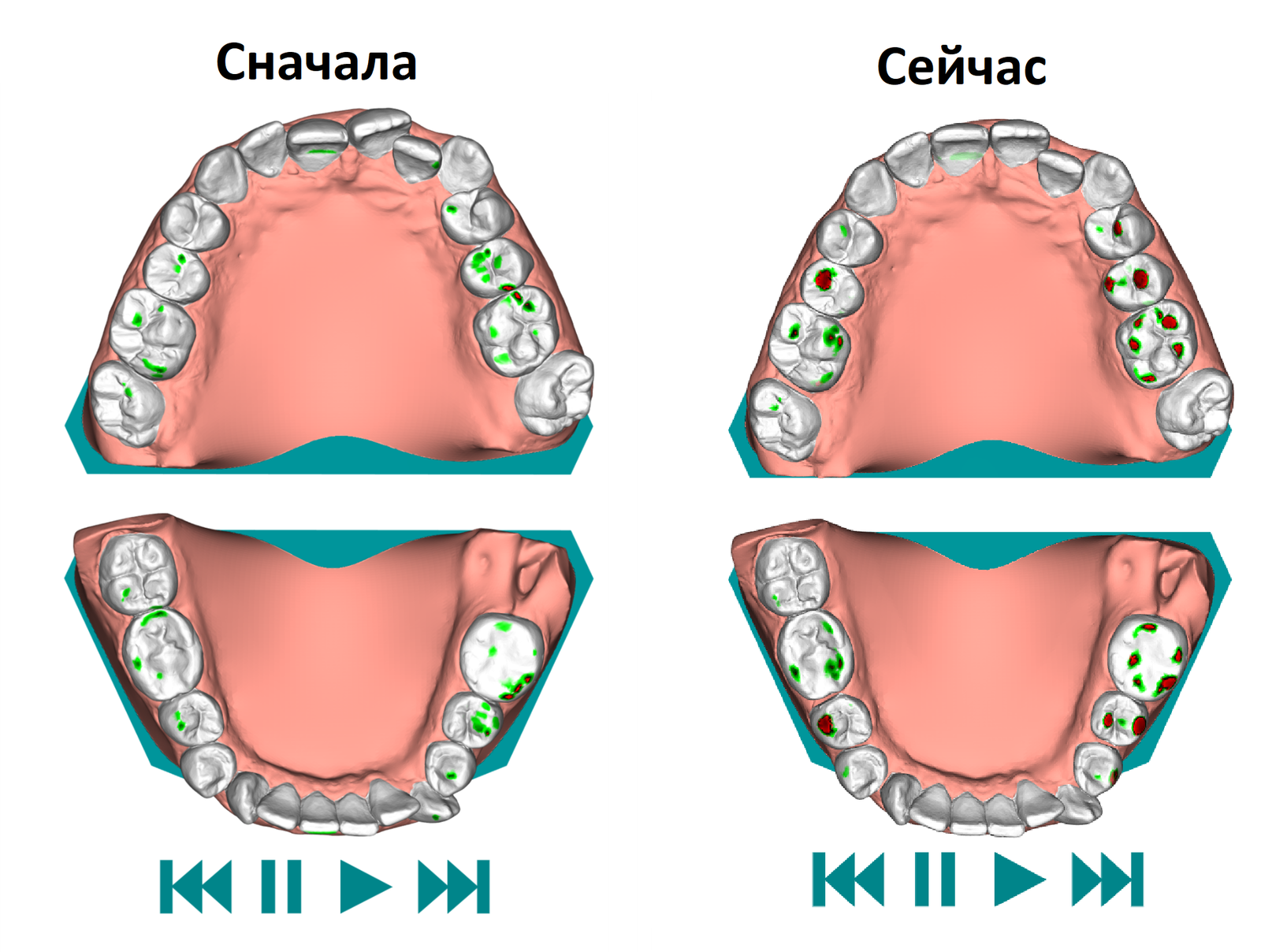 Элайнеры. 15 пара - Моё, Элайнеры, Исправление прикуса, Неправильный прикус, Личный опыт