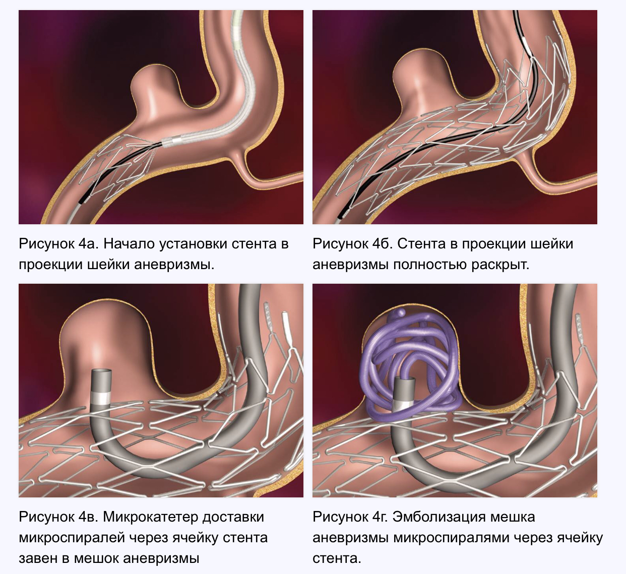 Dissection of the carotid artery, and at the same time the removal of the tonsils with a coblator. - My, Tonsils, Stroke, Chronic tonsillitis, VMP, Medical records, Longpost