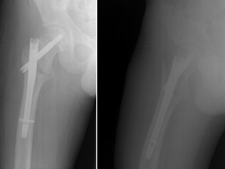 Переломы проксимального отдела бедренной кости - Моё, Медицина, Травматология, Перелом, Шейкабедра, Длиннопост, Бедра