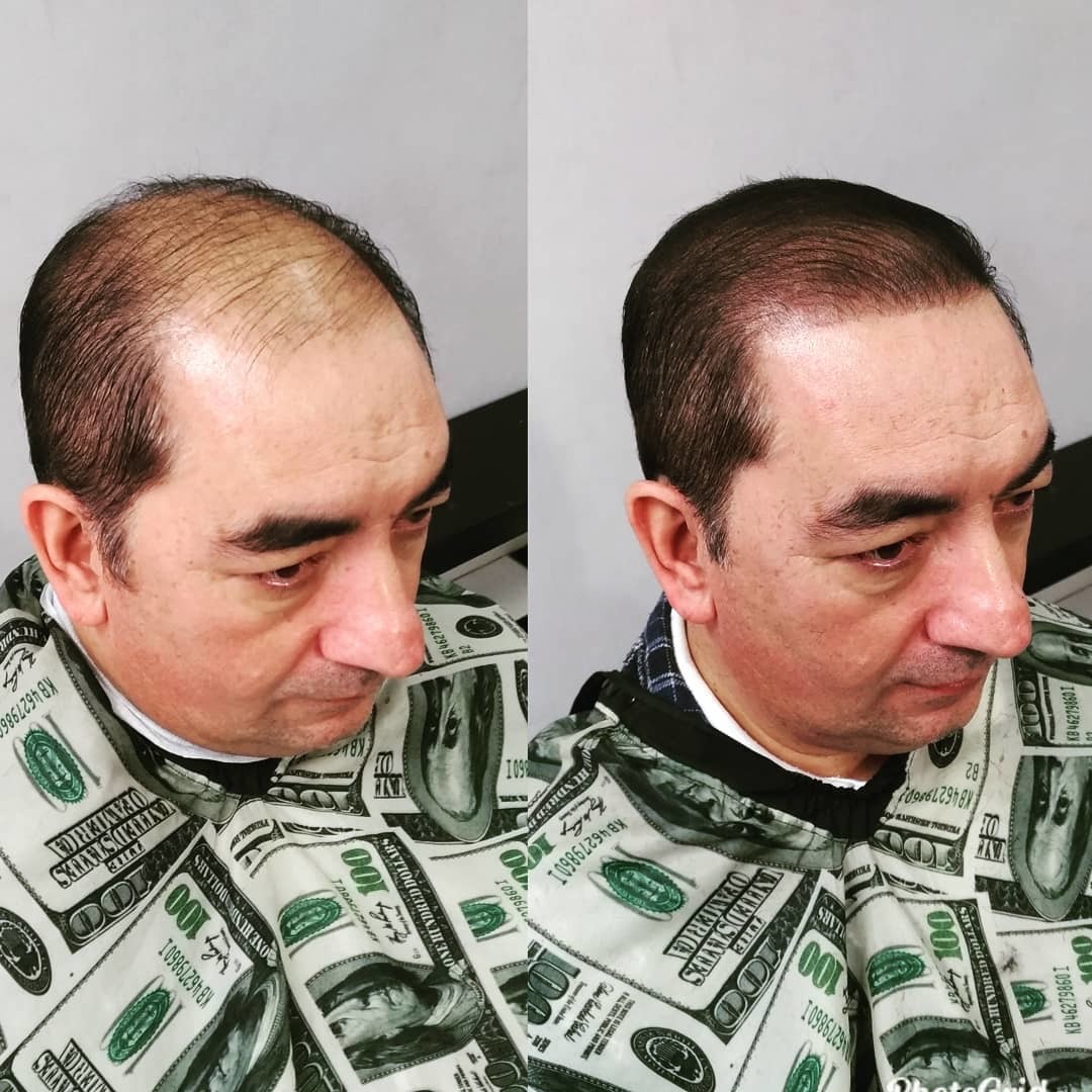 What to do when your hair is thinning. Thickeners - My, Hair, Baldness, Hair Transplant, beauty, Appearance, Cosmetology, The hairdresser, Прическа, Video, Longpost