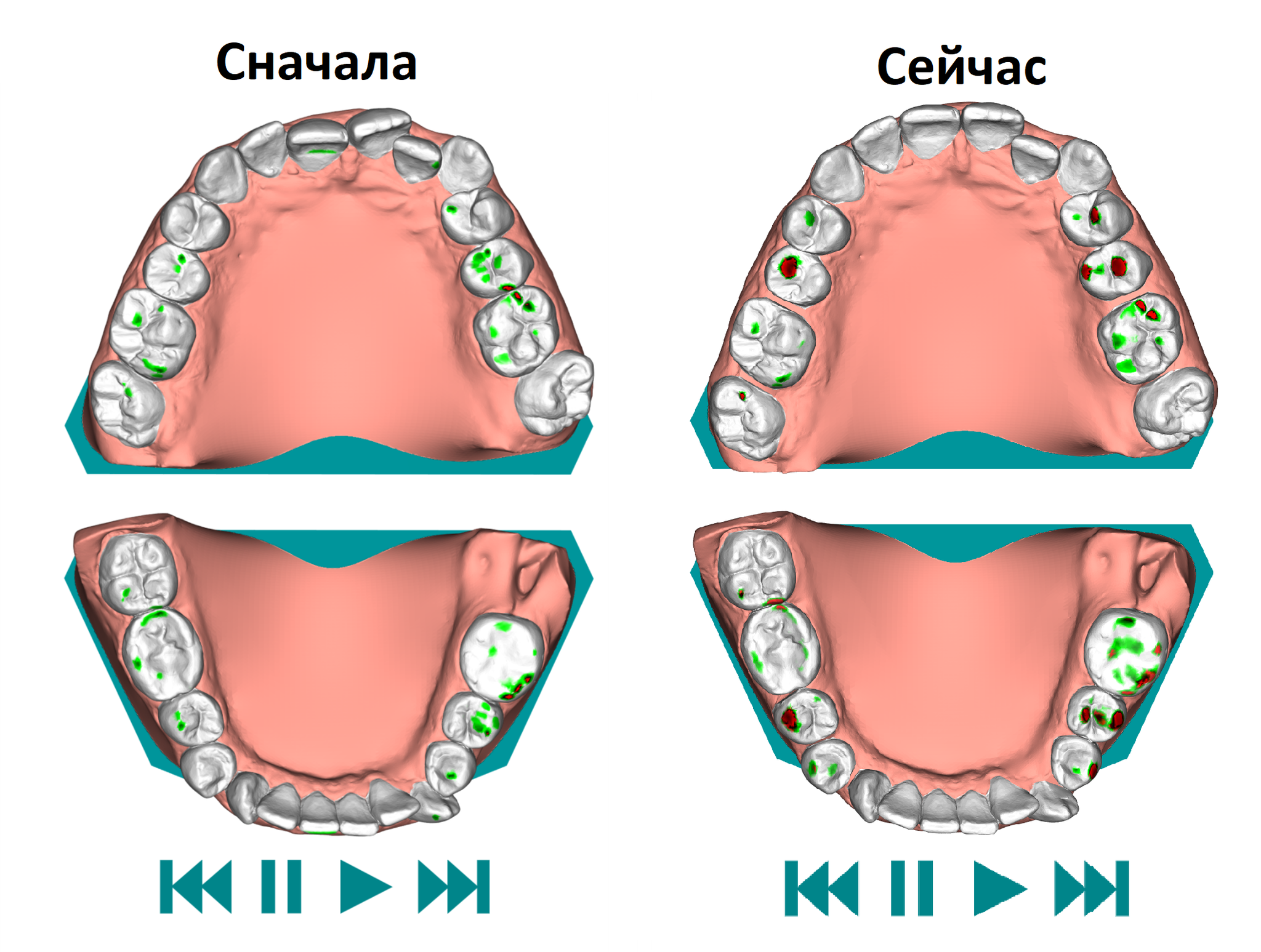 Элайнеры. 18-21 пары - Моё, Элайнеры, Исправление прикуса, Неправильный прикус, Личный опыт, Длиннопост