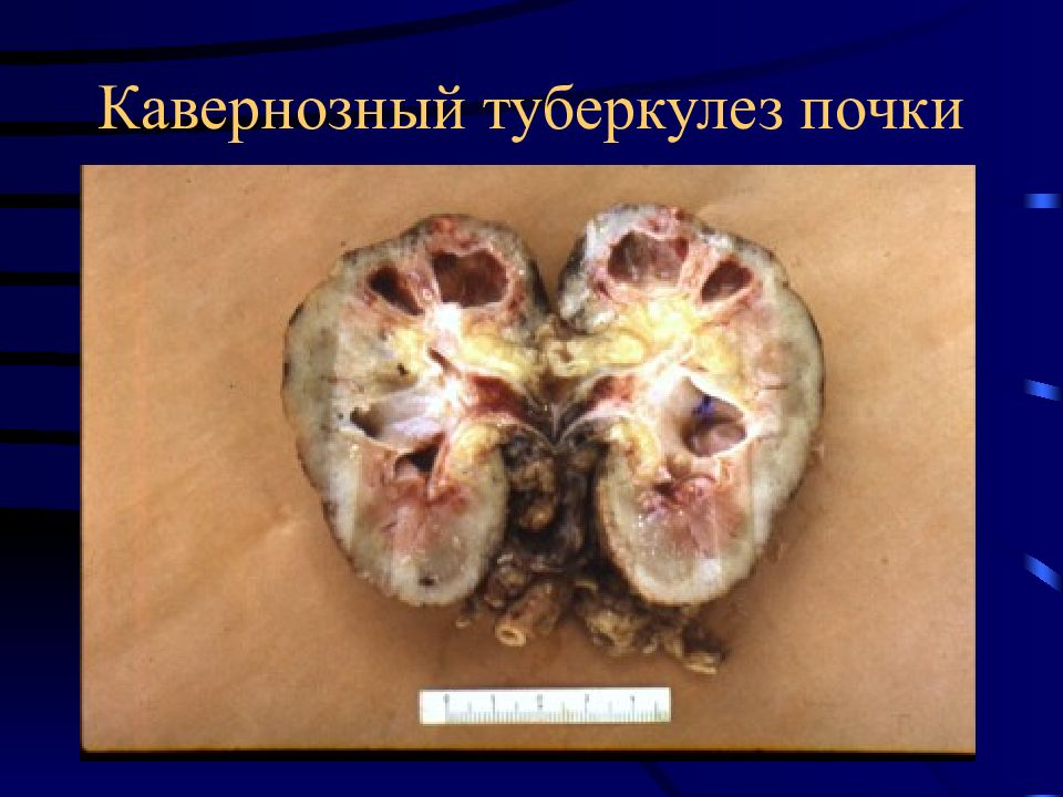 Tuberculosis - My, The medicine, Tuberculosis, Hyde, Mat, Longpost