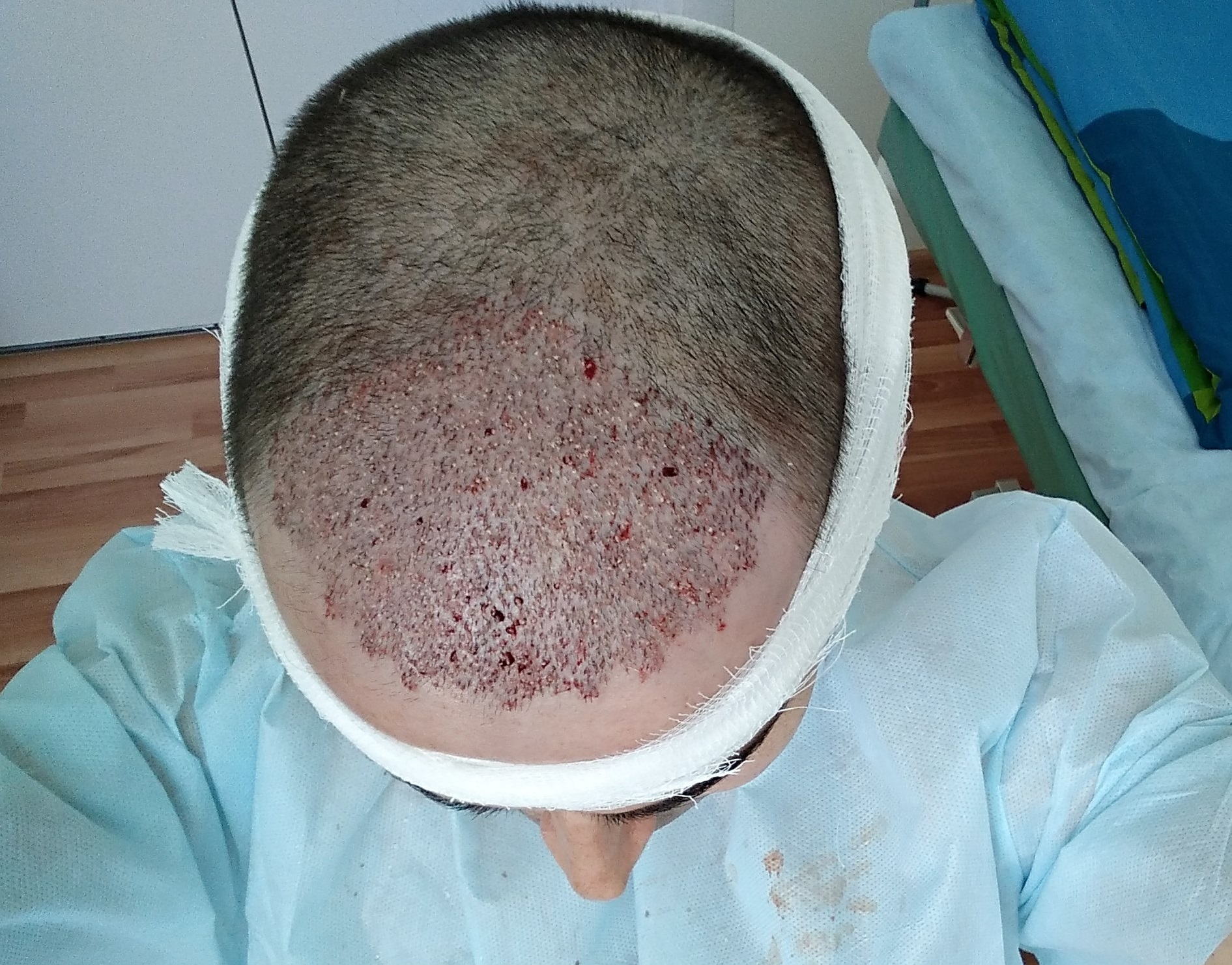 Hair transplantation. - My, Hair Transplant, Minoxidil, Longpost