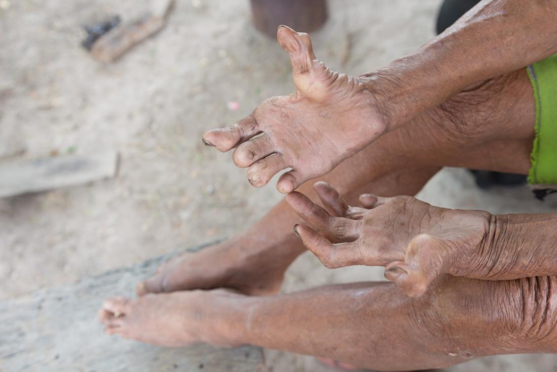 Life for others - Leprosy (disease), Help, Deed, Longpost