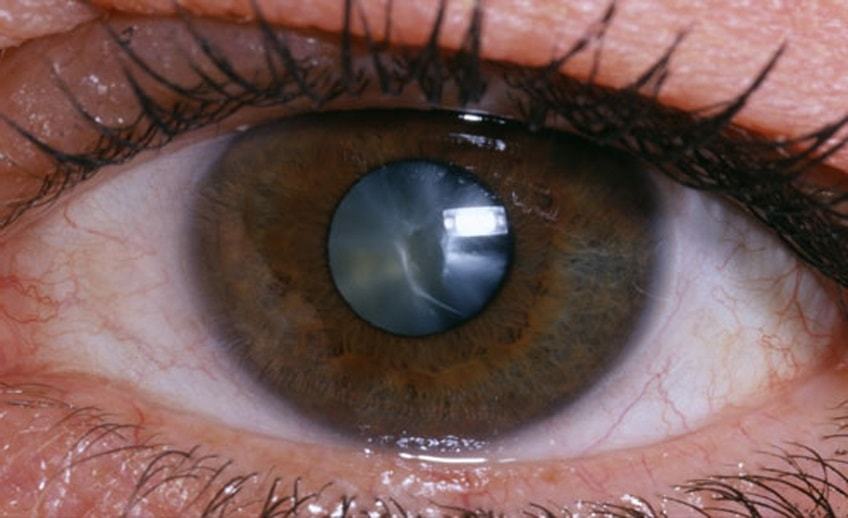 Cataracts, before and after... - My, Cataract, Health, Video, Longpost, Vision, The medicine