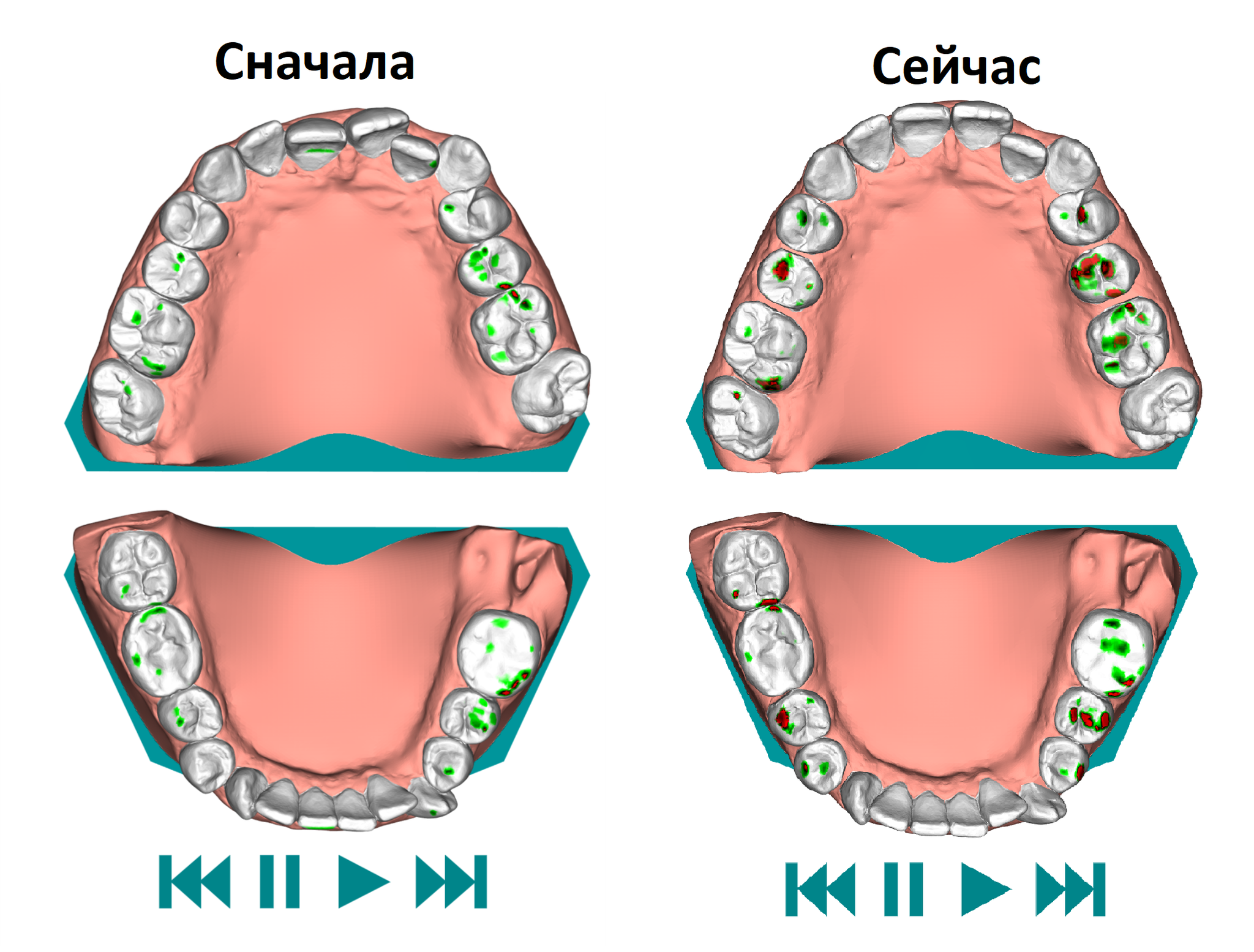 Aligners. First year - My, Aligners, Bite correction, Malocclusion, Personal experience