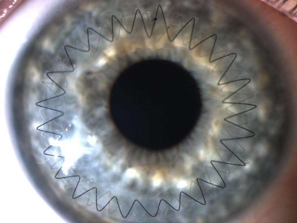 Suture after corneal transplant surgery - Eyes, Operation, Longpost