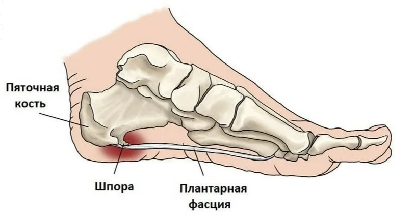 Foot pathology for everyone - Traumatology, The medicine, Feet, Longpost