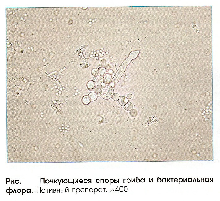 Споры гриба в соскобе. Дрожжевые грибы в моче микроскопия. Споры дрожжевого грибка в моче. Дрожжи в моче микроскопия. Грибы в моче микроскопия.