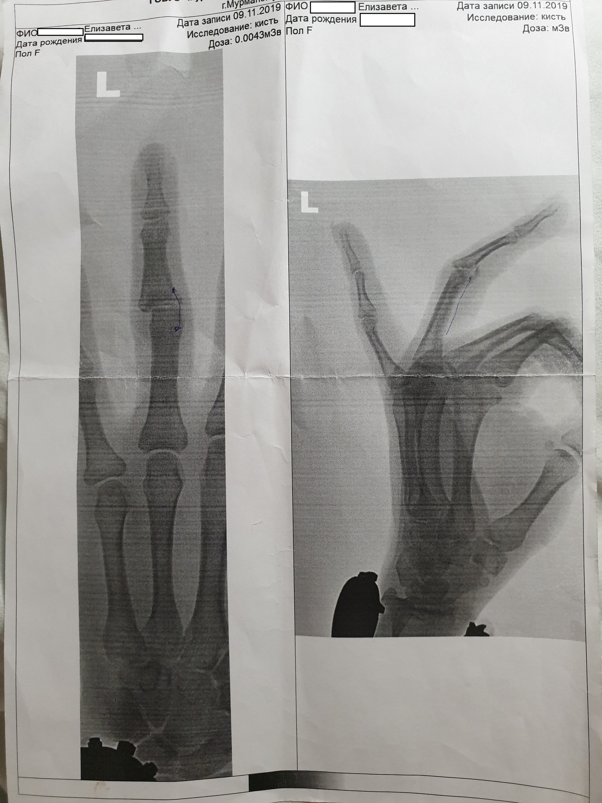 My hands are not for boredom 2.0 Symmetry. part 1 - My, Injury, Operation, Fingers, Hospital, Ilizarov apparatus, Doctors, The photo, Text, Longpost