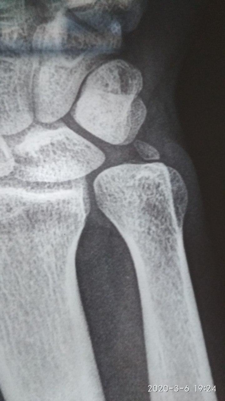 Fracture. Hand. Ice - My, The medicine, Fracture, Surgeon, Traumatology, Doctors, Doctor, Longpost