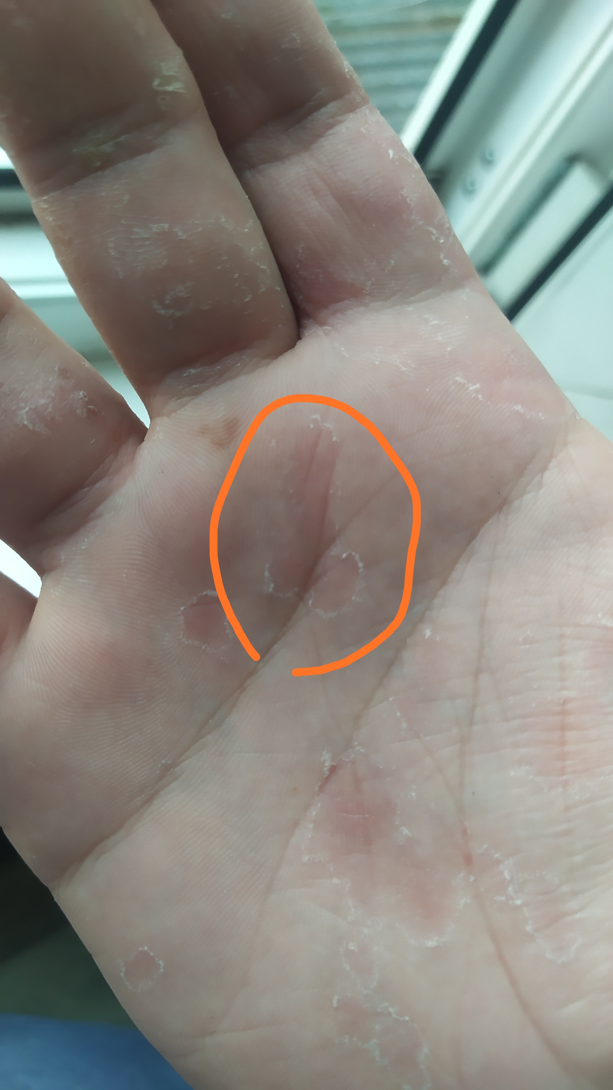 When your hand sucks - My, Dermatitis, Hand