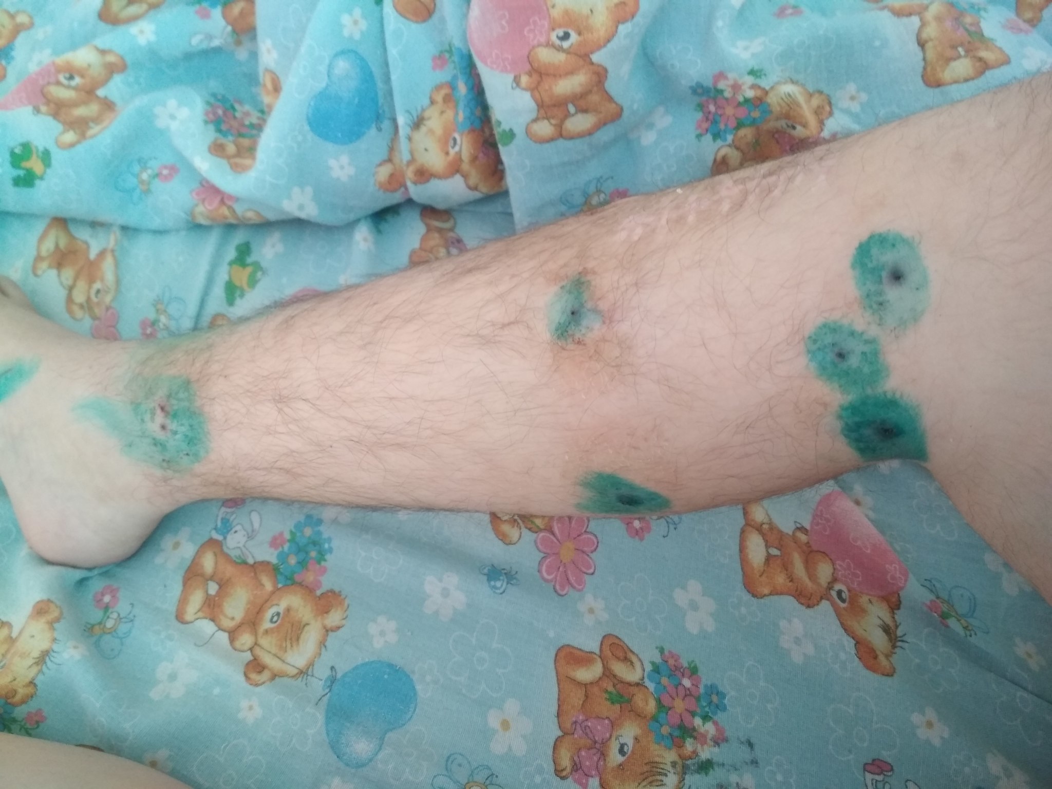 Rehabilitation after removal of the Ilizarov apparatus - My, Legs, Shaving, Scar, Crutches, Quarantine, Rehabilitation, Diary, PHYSICAL THERAPY, Longpost