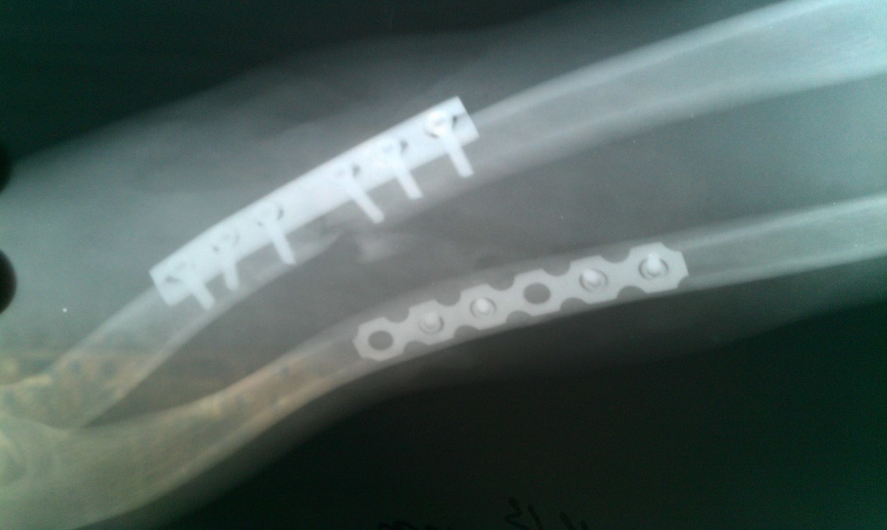 Defect after a fracture of the right forearm - Broken arm, Doctors need help, Longpost