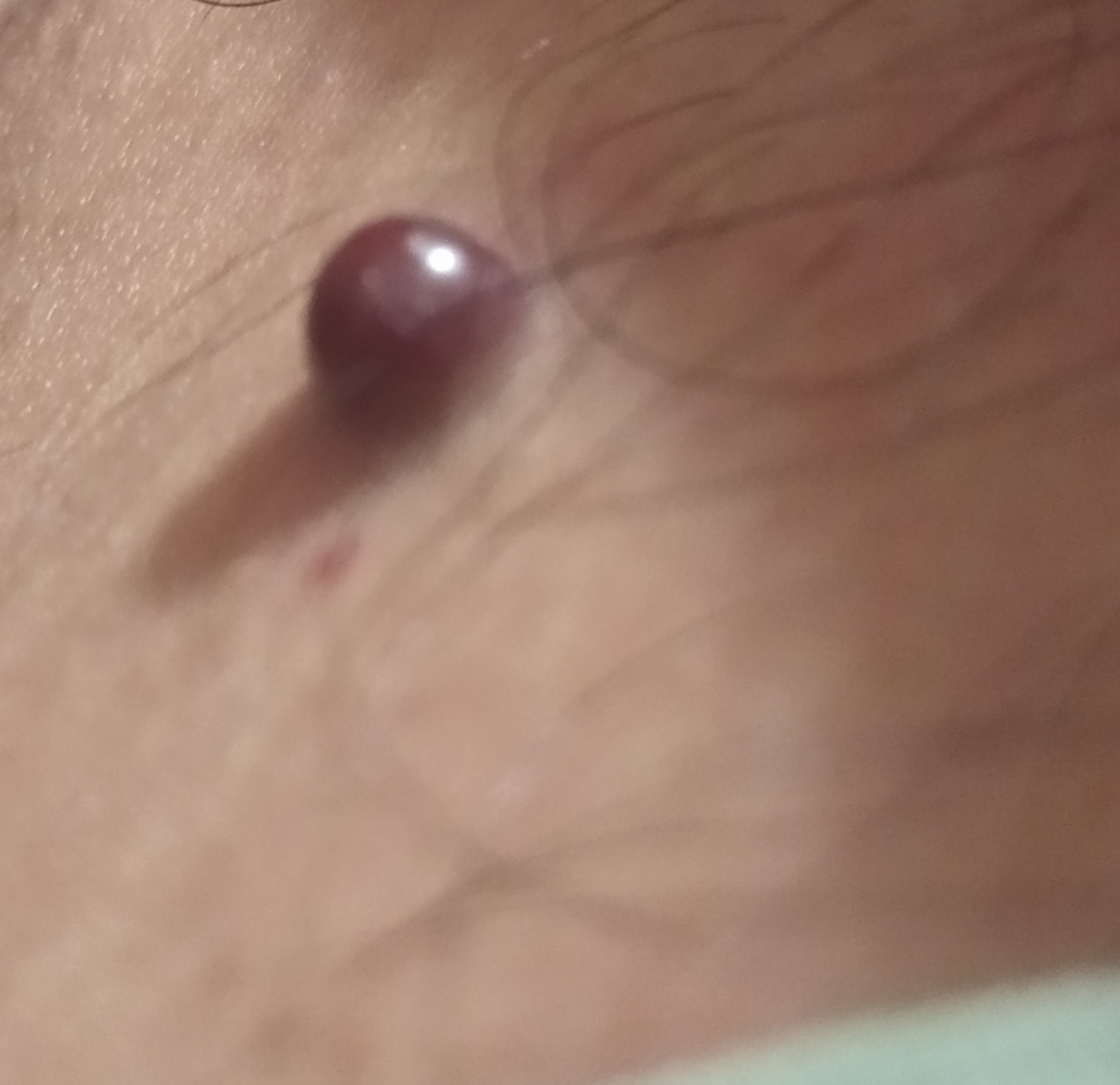 Help is needed. Mole - My, Birthmarks, Question, Dermatology, Longpost