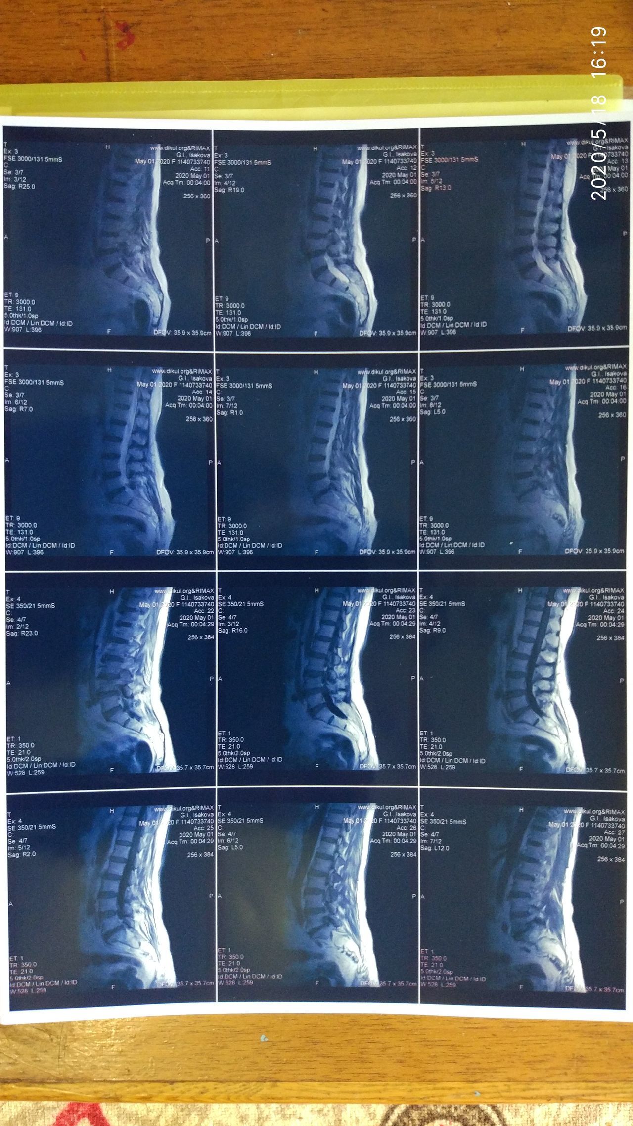 Need help from a neurologist or oncologist - MRI, Legs, Disease, Longpost