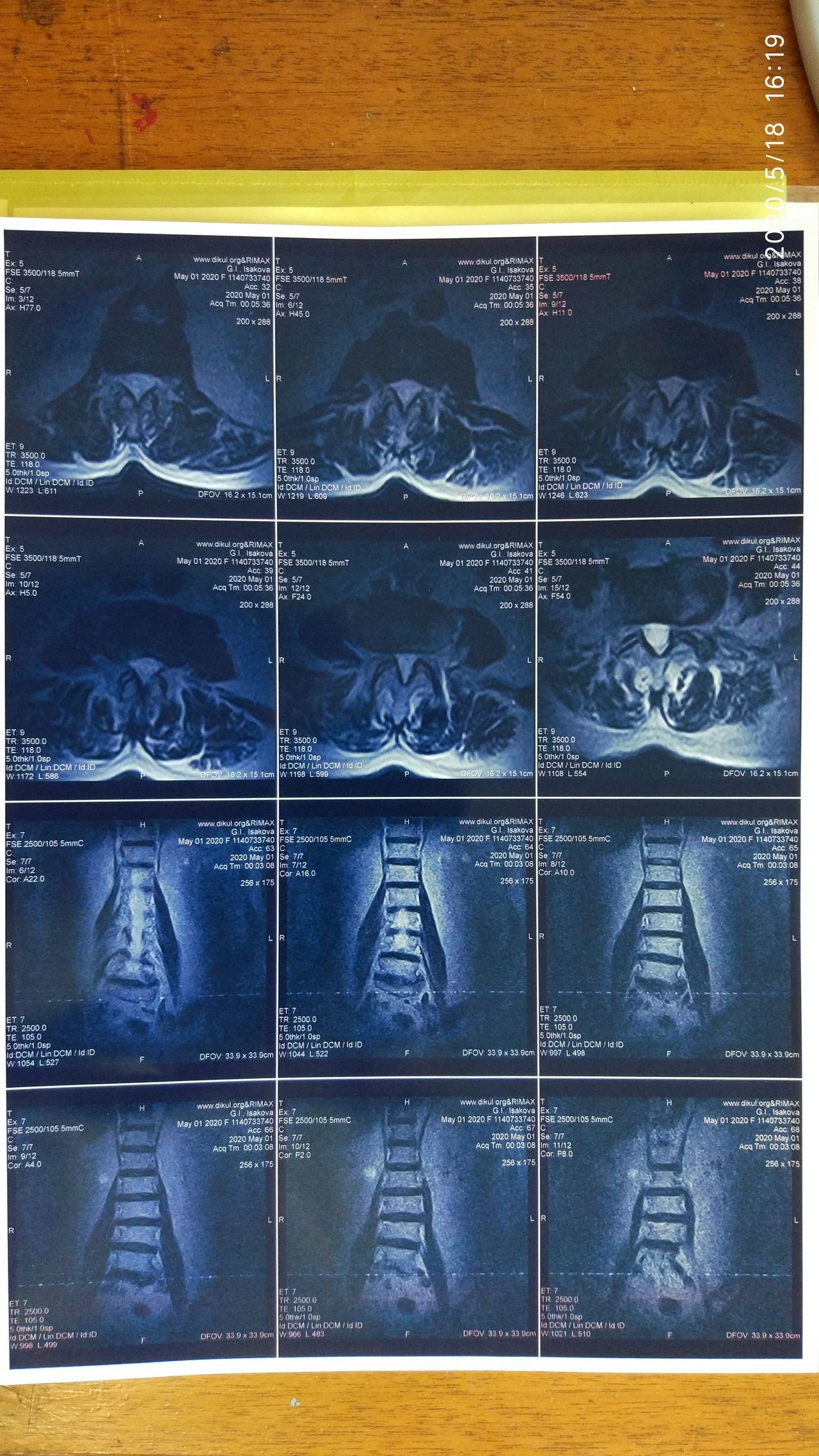 Need help from a neurologist or oncologist - MRI, Legs, Disease, Longpost