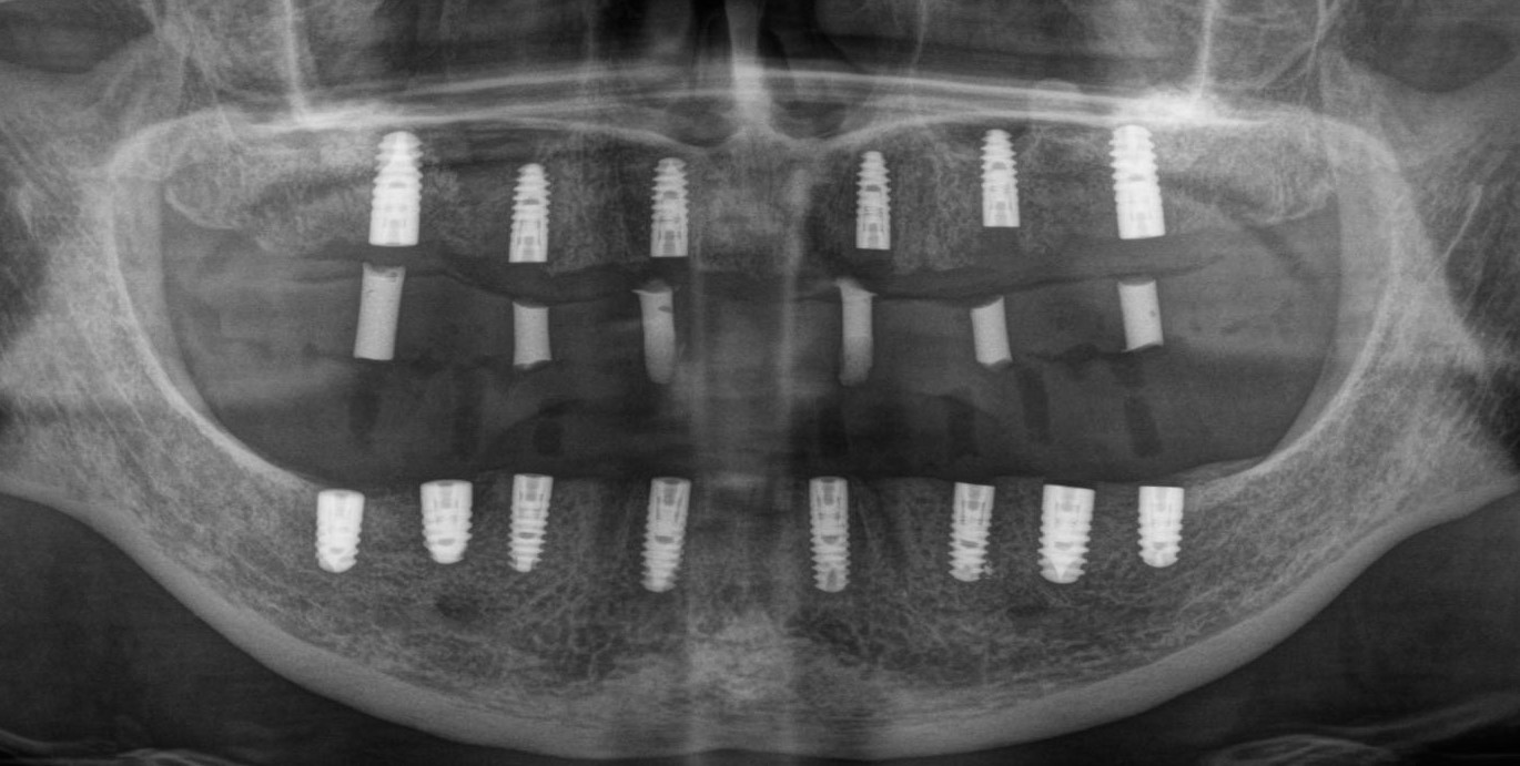 Total prosthetics on implants - My, Dentist, Dentistry, Implantation, Dental implantation, Extraction of teeth, Teeth, Doctors, Longpost