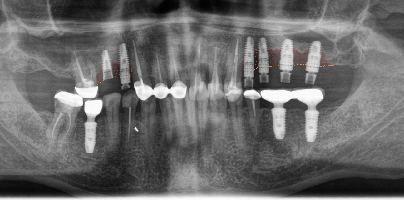 Professional oral hygiene. Part I - My, Dentist, Dentistry, Doctors, Teeth, Dental implantation, Oral hygiene, The medicine, Doctor, Mat, Longpost