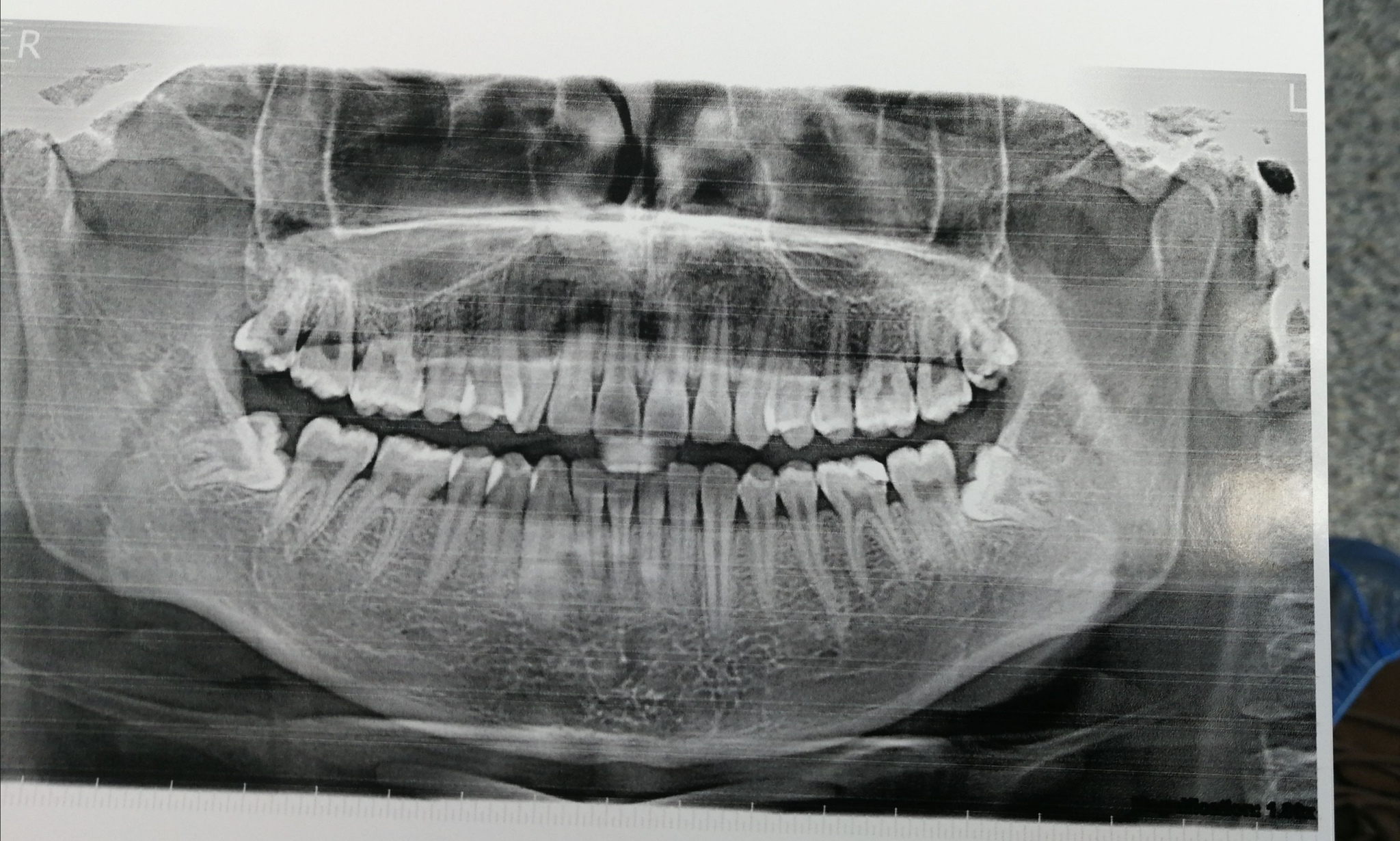 Pikabu - need advice - My, Dentistry, Incompetence, TMJ dysfunction, Longpost, No rating