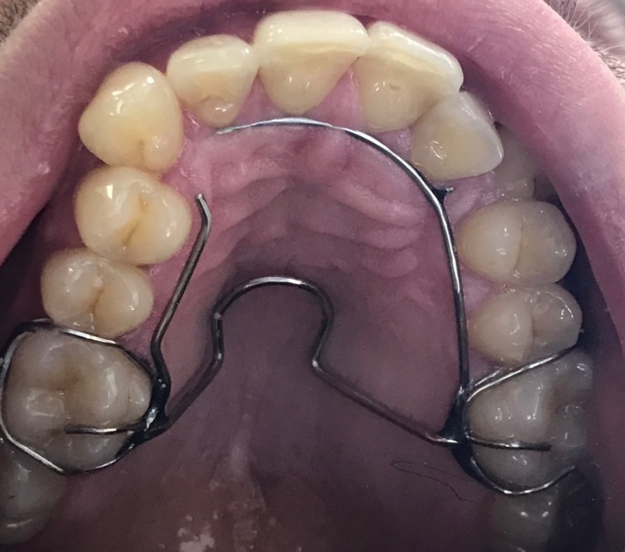 Alternative to braces - My, Braces, Teeth, Apparatus, Wire, Longpost