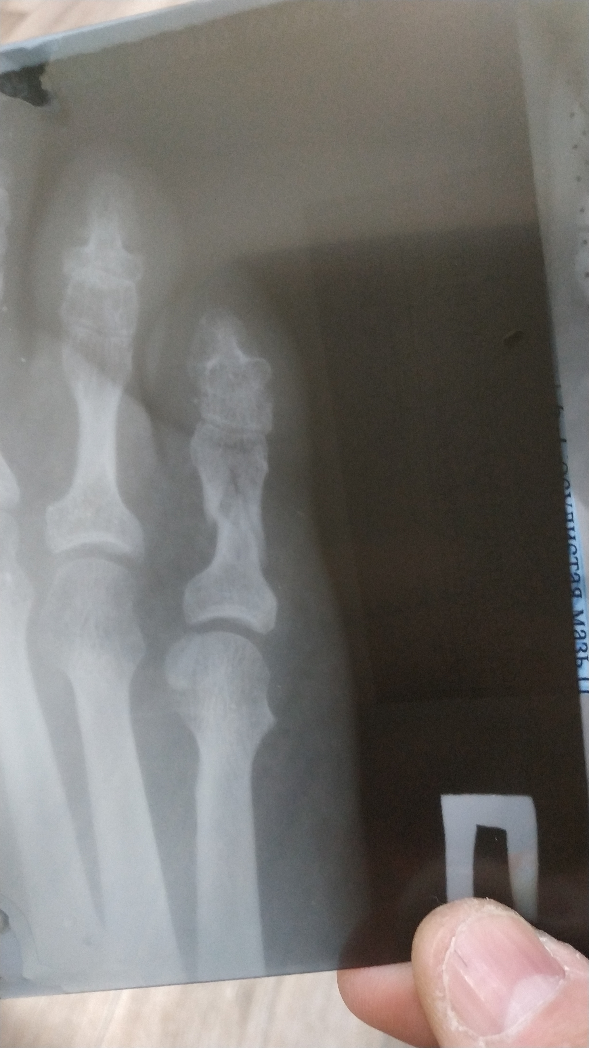 How to heal a fracture faster? - My, Broken leg, Little finger, Sick leave